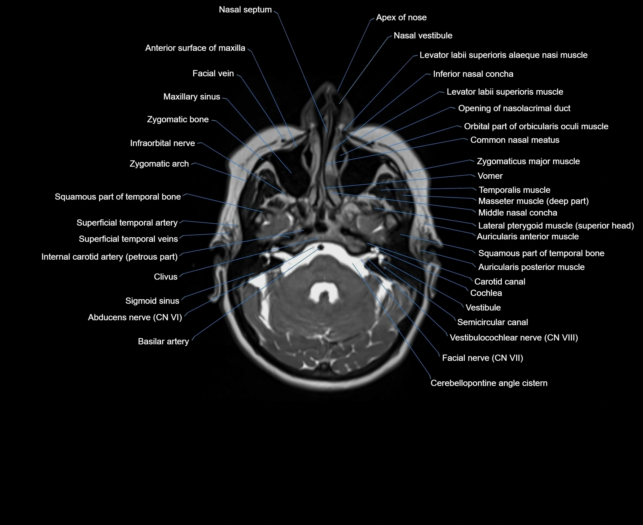MRI Neck 3D labelled cross section anatomy axial 3t image-00001-00009.webp